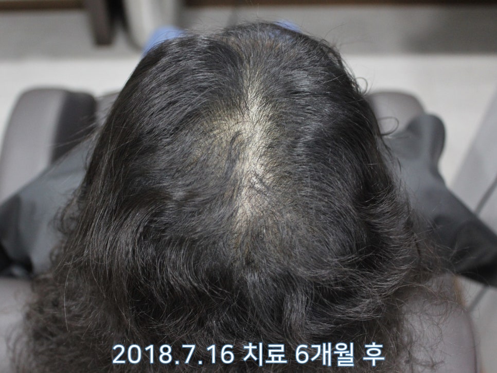 연세봄빛피부과 탈모치료 #10 (여성형탈모, 정수리탈모) 관련 이미지 5