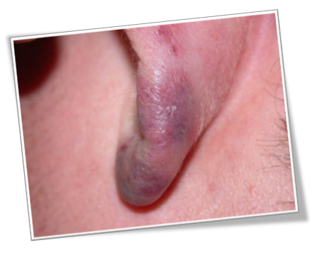 동상과 동창, 겨울의 불청객 #2 (동창) 관련 이미지 2