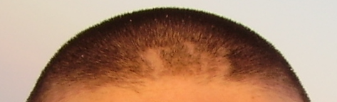 머리뽑는습관으로 생기는 탈모, 발모벽 관련 이미지 3