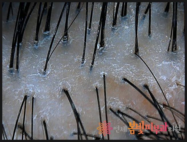 연세봄빛피부과 탈모치료 #10 (여성형탈모, 정수리탈모) 관련 이미지 6