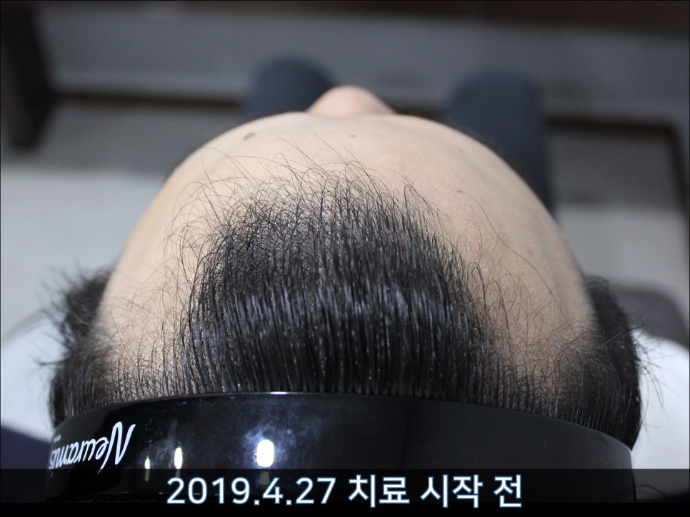 연세봄빛피부과 탈모치료 #42 (남성형탈모,M자탈모) 관련 이미지 2