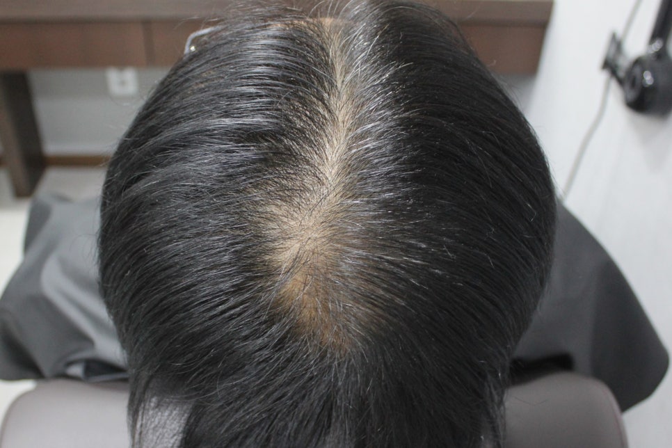 연세봄빛피부과 탈모치료 #5 (남성형탈모, 이마탈모, 정수리탈모) 관련 이미지 4
