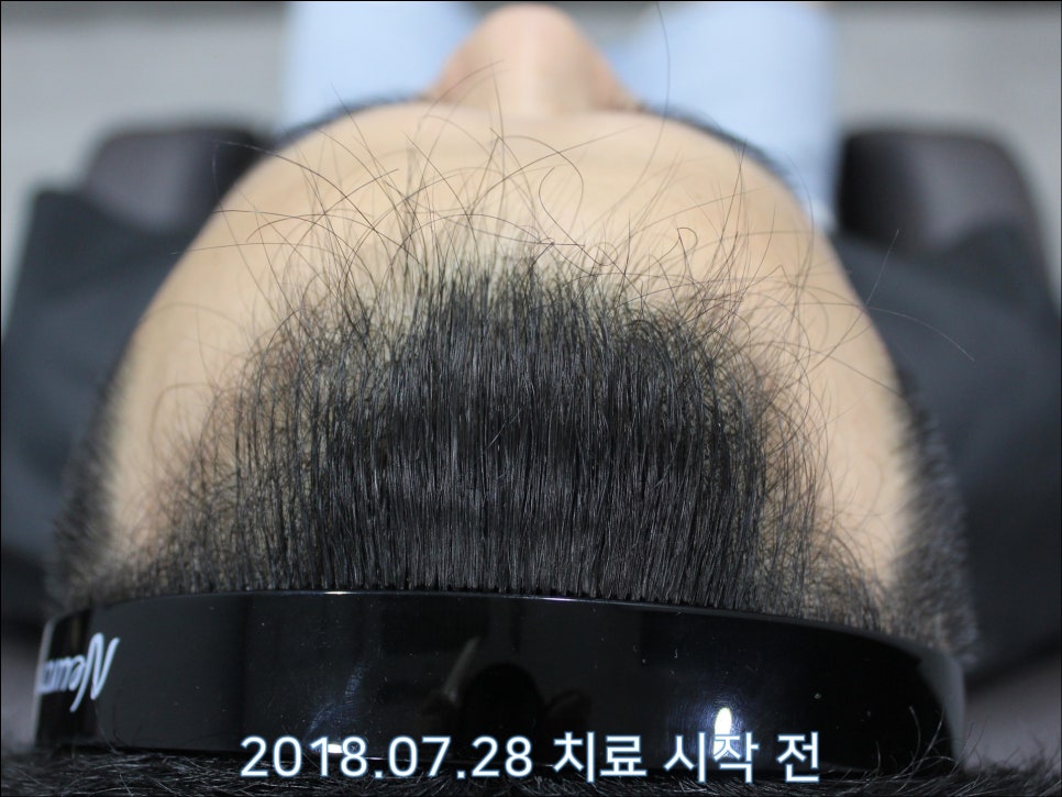 연세봄빛피부과 탈모치료 #27 (남성형탈모, 이마탈모 정수리탈모) 관련 이미지 4