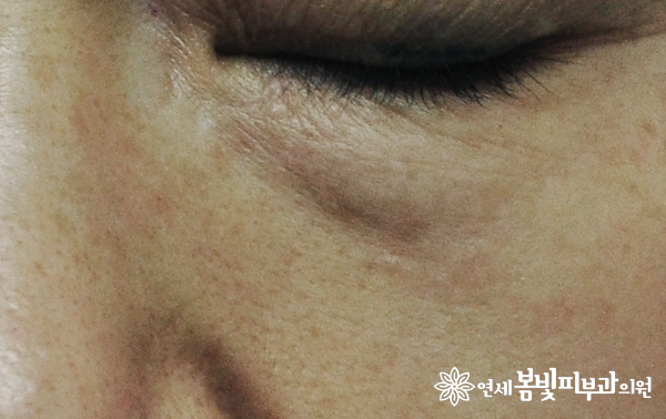 다크써클 없애는법 #3 (다크써클 치료: 레이저 치료, 색소 레이저, 레이저 토닝, 혈관 레이저, 탄력 레이저, 하이푸) 관련 이미지 6