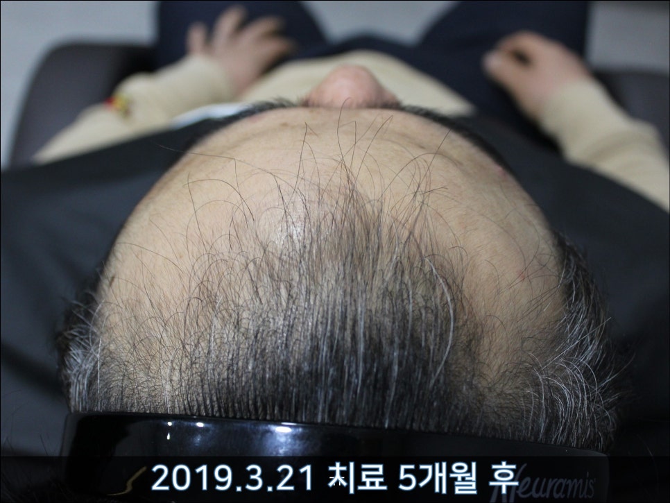 연세봄빛피부과 탈모치료 #30 (남성형탈모, 이마탈모, 정수리탈모) 관련 이미지 7