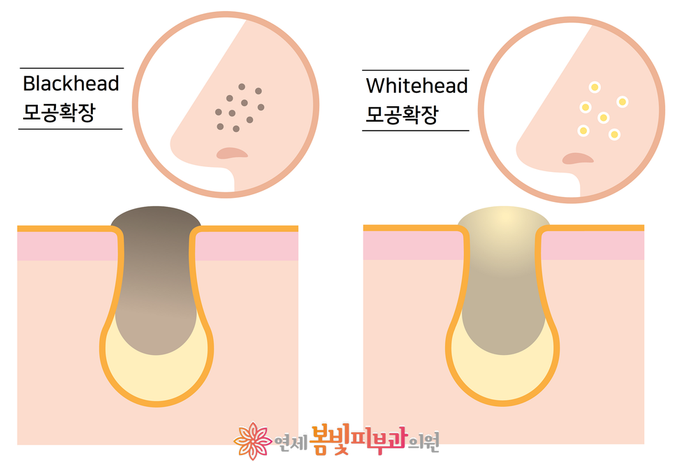 모공줄이는 방법 #1 (모공이 생기는 원인, 분류, 블랙헤드, 화이트헤드, 아쿠아필, 제네시스 레이저) 관련 이미지 4