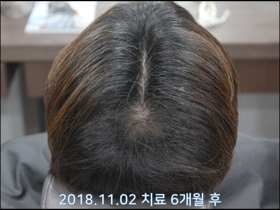 연세봄빛피부과 탈모치료 #23 (남성형탈모, 이마탈모, 정수리탈모) 관련 이미지 3
