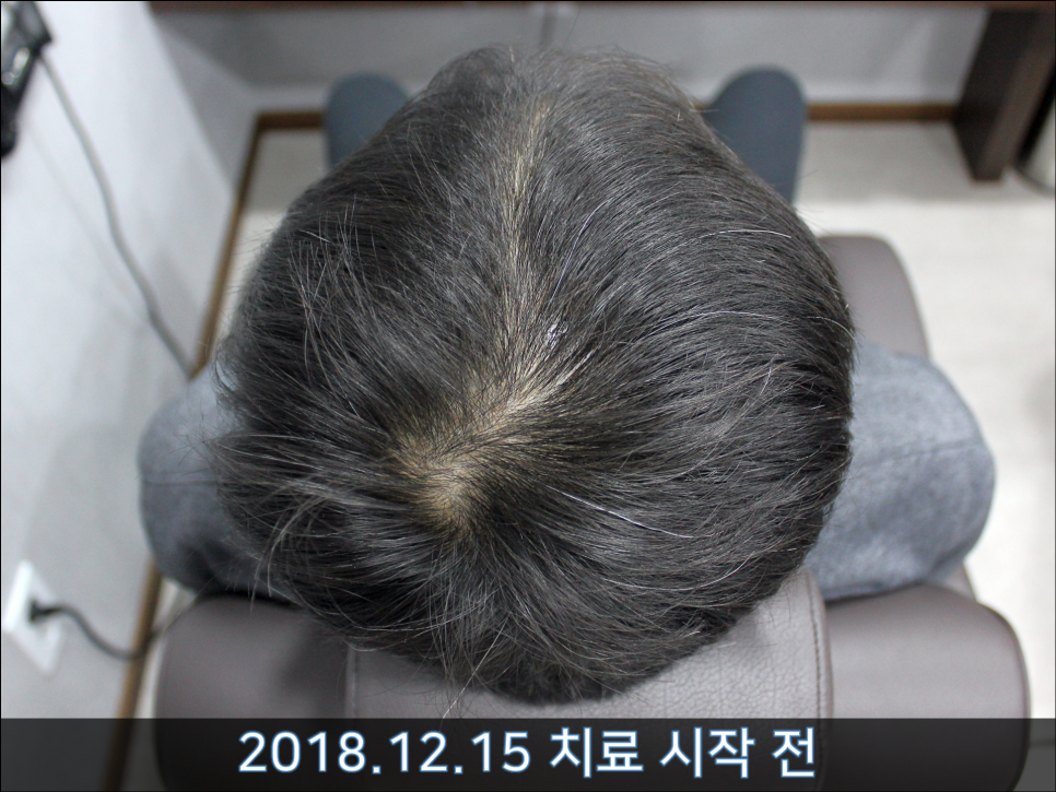 연세봄빛피부과 탈모치료 #36 (남성형탈모, 이마탈모, 3개월) 관련 이미지 5