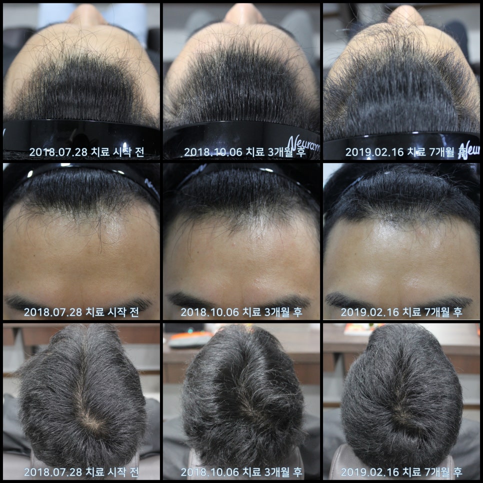 연세봄빛피부과 탈모치료 #27 (남성형탈모, 이마탈모 정수리탈모) 관련 이미지 7