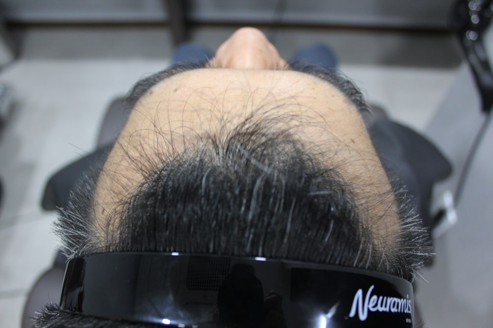 연세봄빛피부과 탈모치료 #4-1 (남성형탈모, 이마탈모, 정수리탈모, 6개월치료 경과 업데이트) 관련 이미지 3