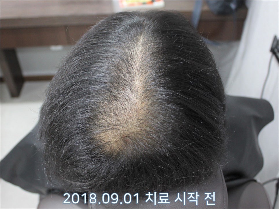 연세봄빛피부과 탈모치료 #29 (남성형탈모, 정수리탈모, 15개월간 장기 치료) 관련 이미지 1
