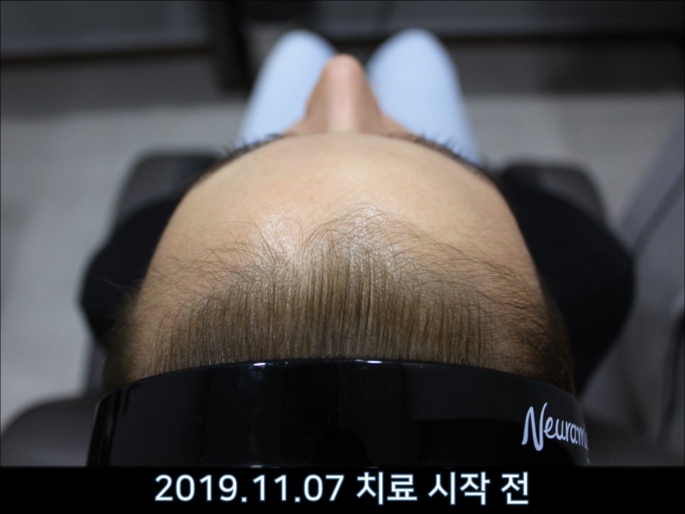 연세봄빛피부과 탈모치료 #40 (여성형탈모, 외국인의 경우) 관련 이미지 4