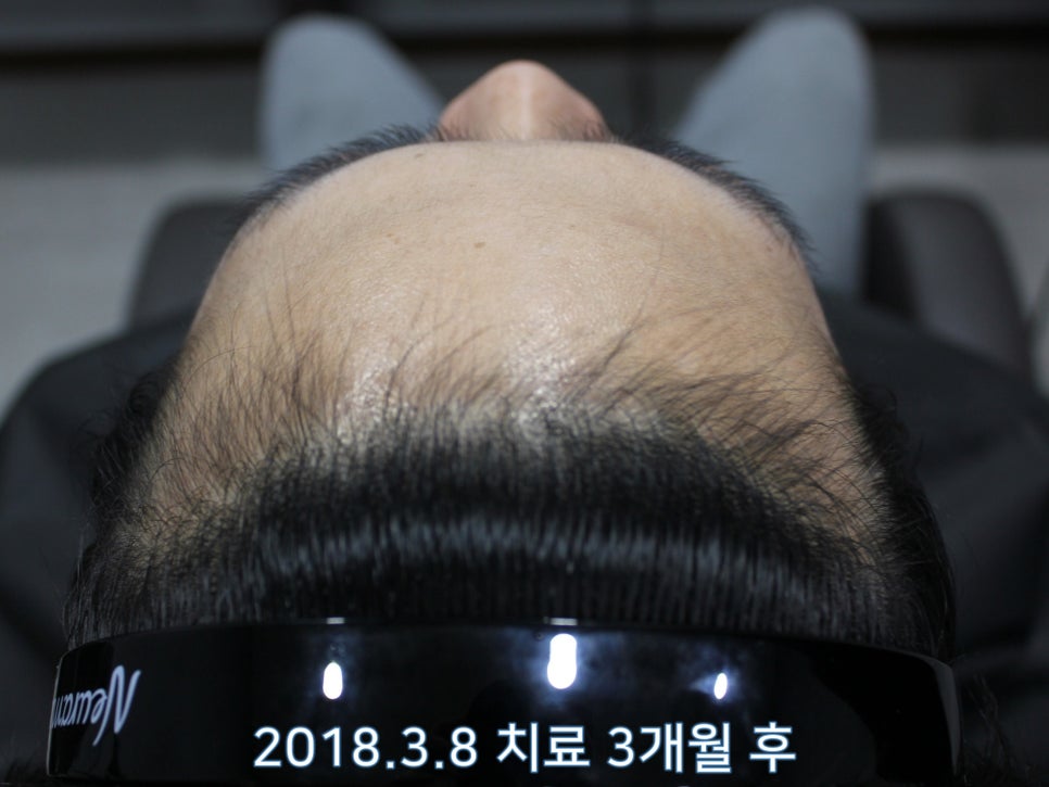 연세봄빛피부과 탈모치료 #7 (남성형탈모, 이마탈모, 정수리탈모) 관련 이미지 2