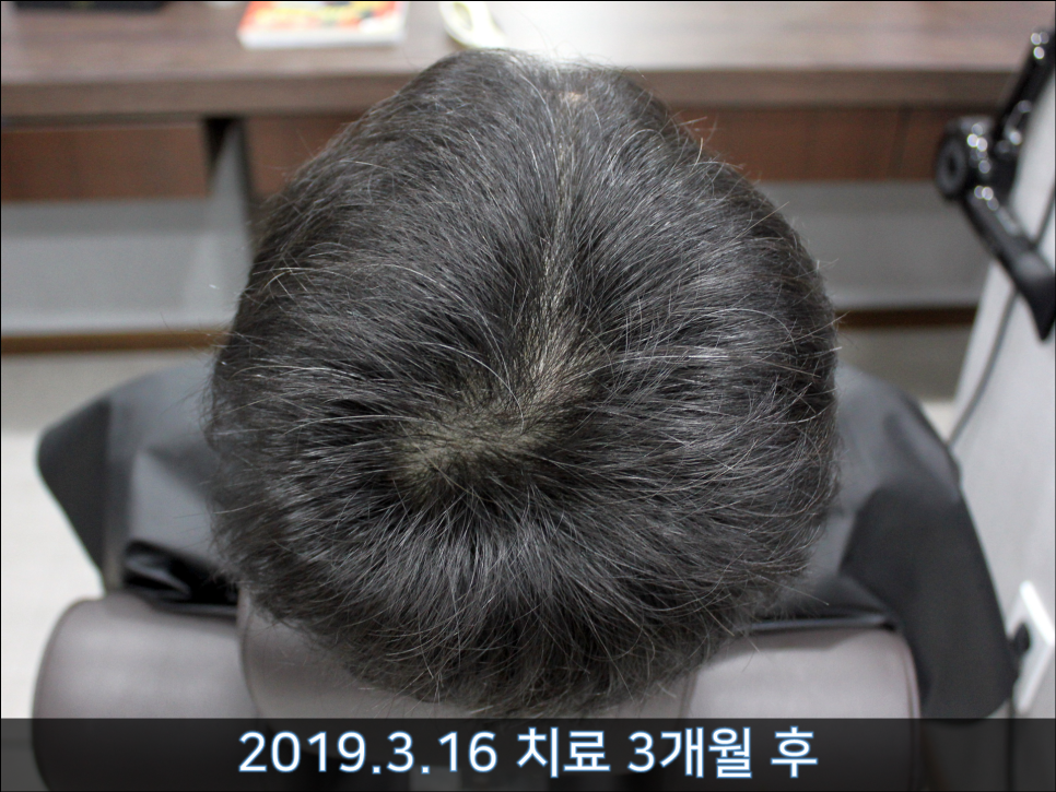 연세봄빛피부과 탈모치료 #36 (남성형탈모, 이마탈모, 3개월) 관련 이미지 6