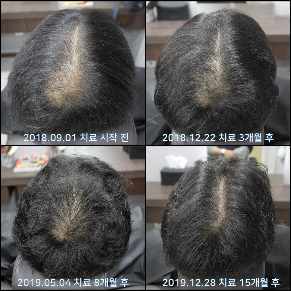 연세봄빛피부과 탈모치료 #29 (남성형탈모, 정수리탈모, 15개월간 장기 치료) 관련 이미지 5