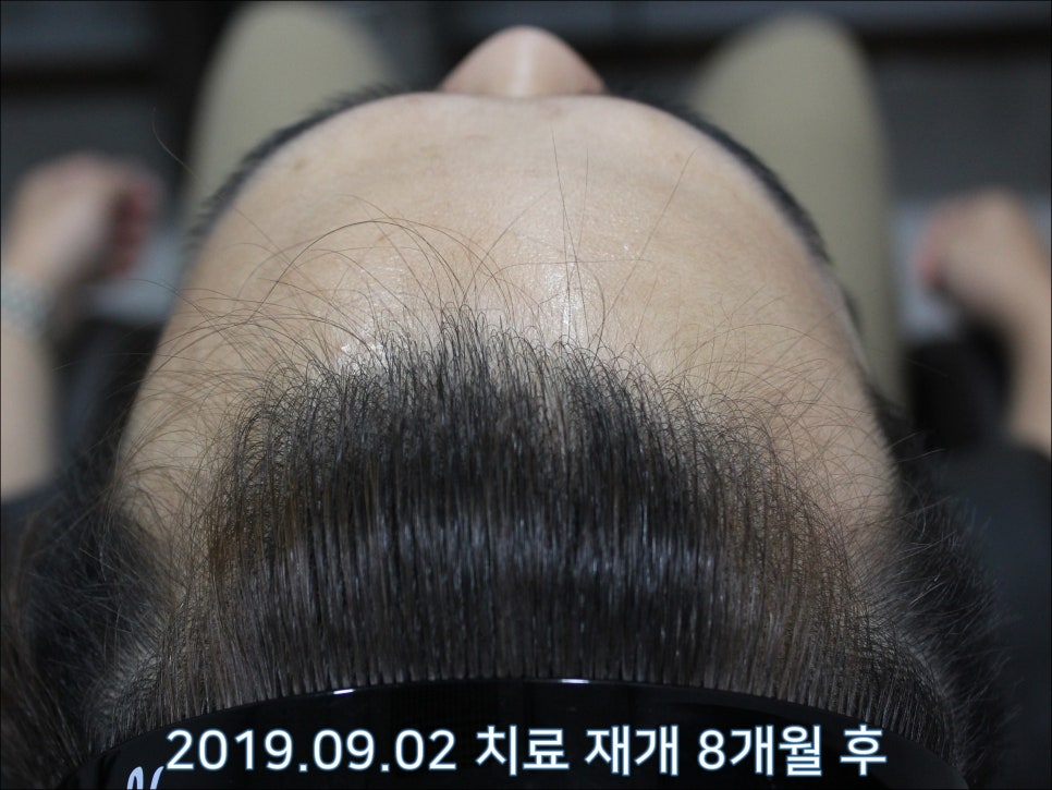 연세봄빛피부과 탈모치료 #25 (남성형탈모, 재치료, 이마탈모, 정수리탈모) 관련 이미지 9