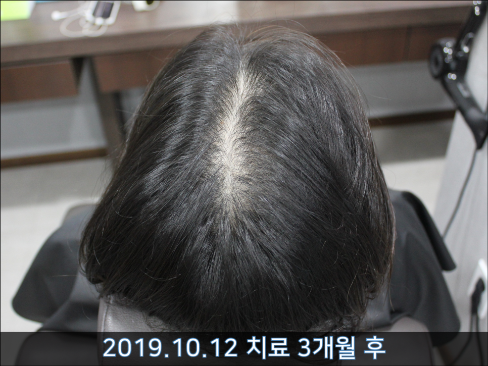 연세봄빛피부과 탈모치료 #38 (여성형탈모, 여성이마탈모) 관련 이미지 6