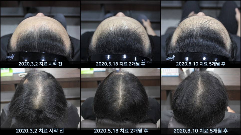 연세봄빛피부과 탈모치료 #44 (남성형탈모,M형+C형탈모) 관련 이미지 1