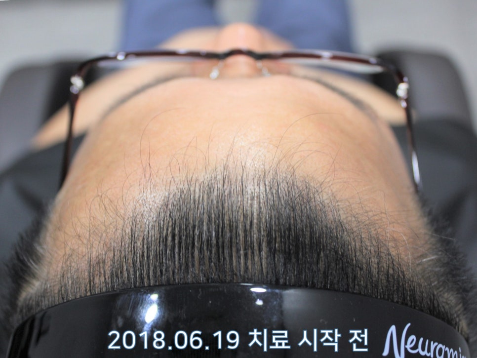 연세봄빛피부과 탈모치료 #16 (남성형탈모, 이마탈모, 정수리탈모, 3단계) 관련 이미지 7