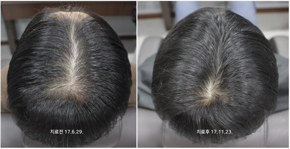 연세봄빛피부과 탈모치료 #2 (남성형탈모, 이마탈모, 정수리탈모) 관련 이미지 8