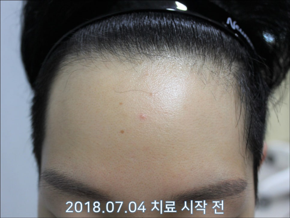 연세봄빛피부과 탈모치료 #26 (남성형탈모, 이마탈모) 관련 이미지 1