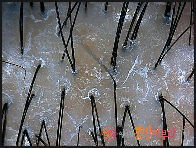 연세봄빛피부과 탈모치료 #10 (여성형탈모, 정수리탈모) 관련 이미지 4