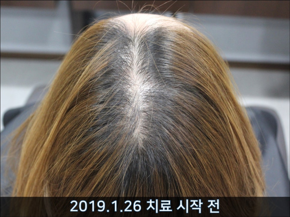 연세봄빛피부과 탈모치료 #37 (여성형탈모, 정수리탈모) 관련 이미지 1