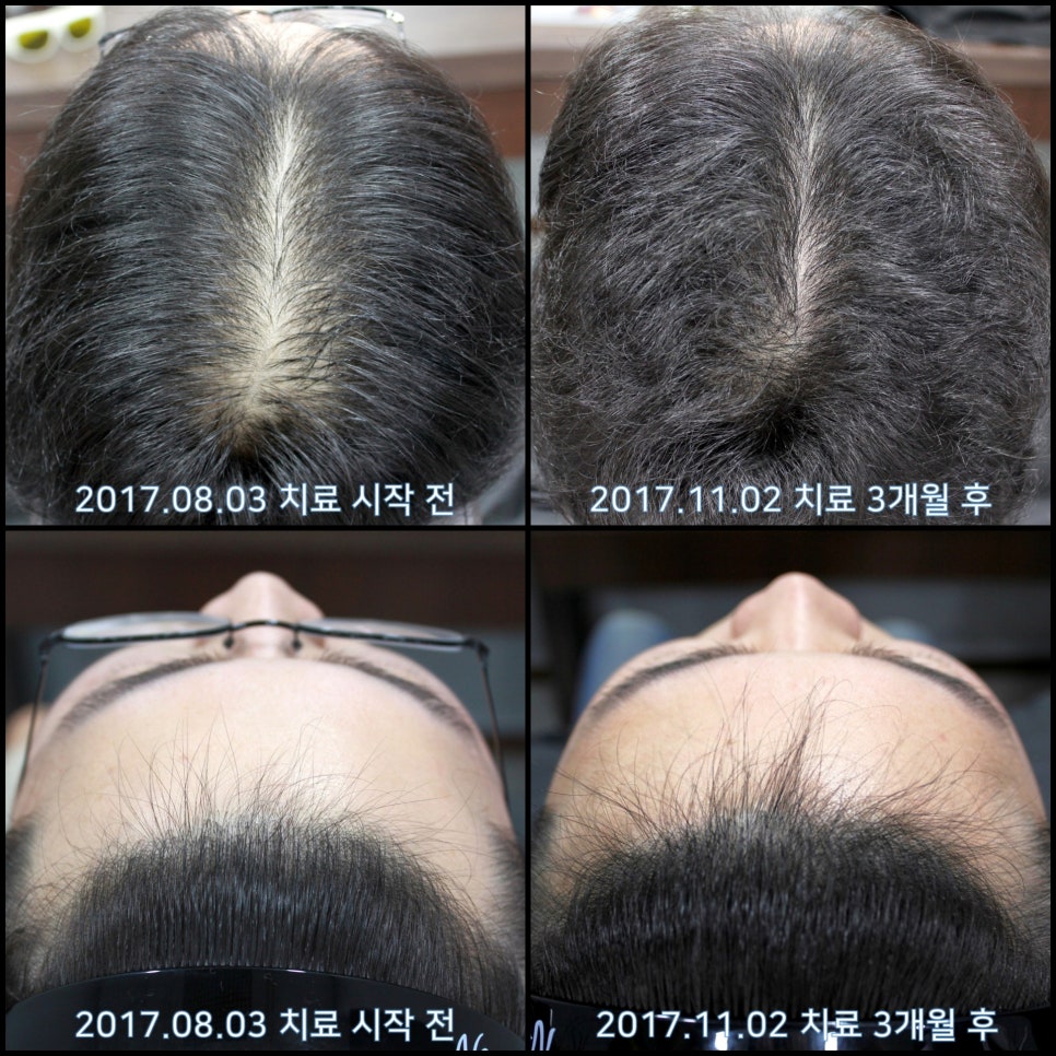 연세봄빛피부과 탈모치료 #15 (남성형탈모, 이마탈모, 정수리탈모) 관련 이미지 5
