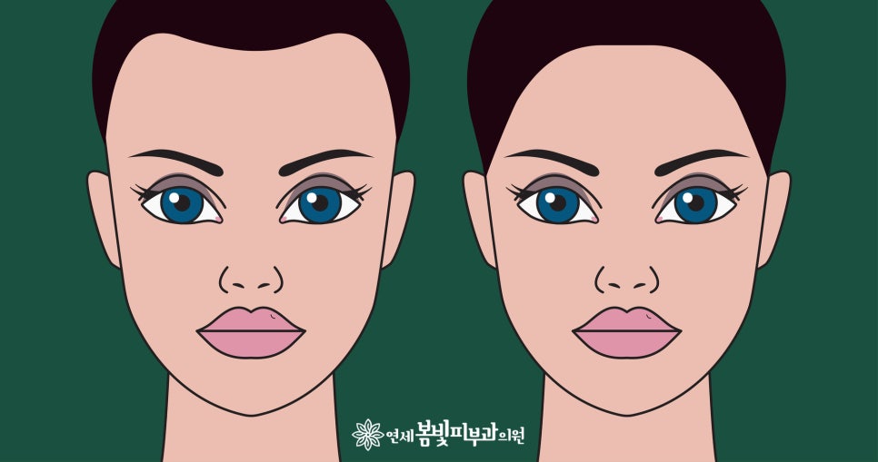 연세봄빛피부과 탈모치료 #24 (여성형 탈모, 이마탈모, 정수리탈모) 관련 이미지 1