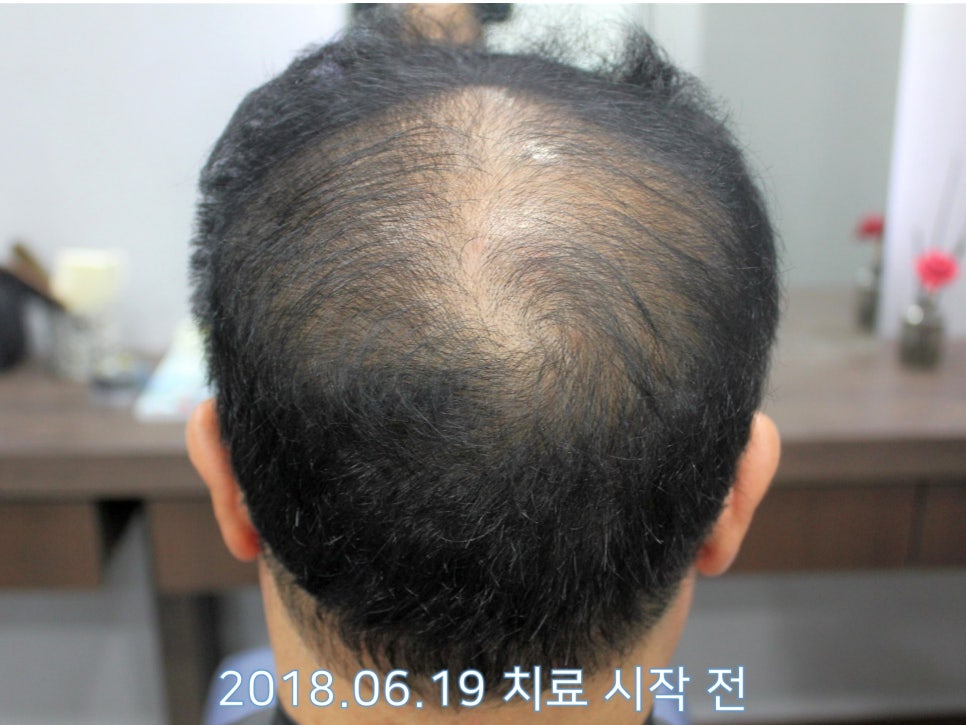 연세봄빛피부과 탈모치료 #16 (남성형탈모, 이마탈모, 정수리탈모, 3단계) 관련 이미지 4