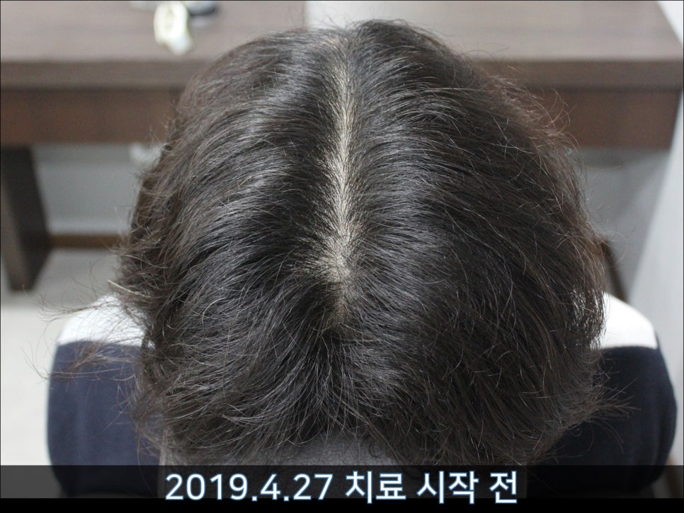연세봄빛피부과 탈모치료 #42 (남성형탈모,M자탈모) 관련 이미지 10