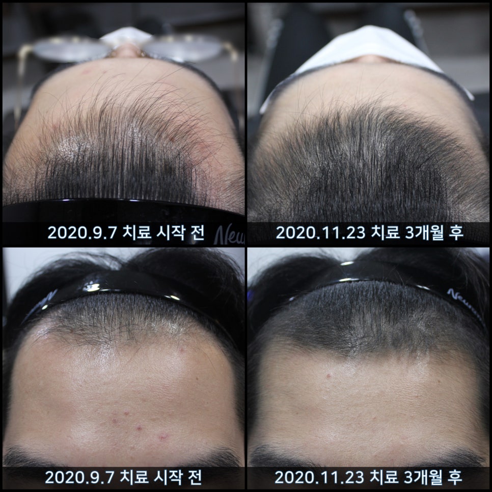 연세봄빛피부과 탈모치료 #32 (남성형탈모, 이마탈모, 정수리탈모, 두피보톡스) 관련 이미지 5