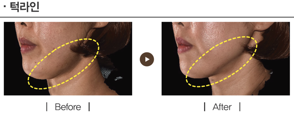 리프팅 레이저의 새로운 강자, 울트라스킨 플러스 도입 관련 이미지 7