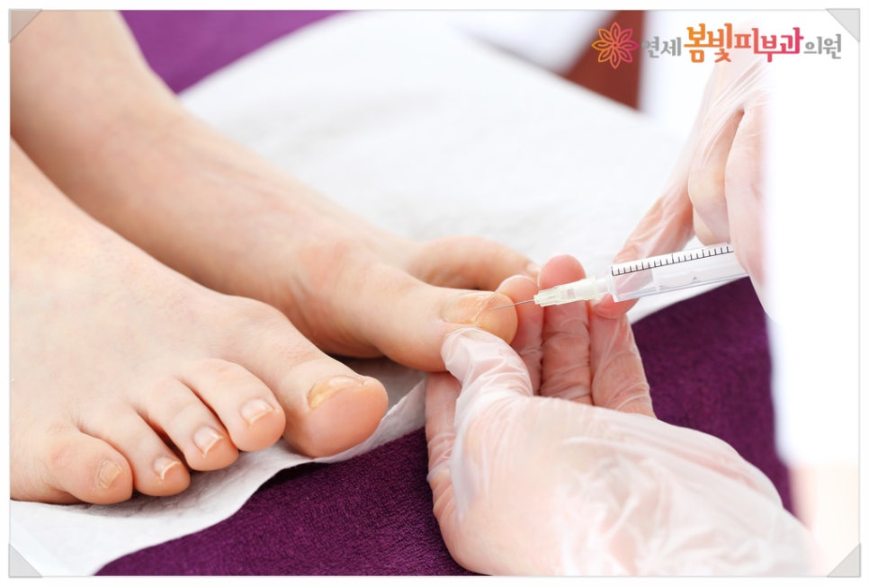 바이러스성 사마귀, 어떻게 치료 하나요? (사마귀 치료 방법, 냉동 치료, 블레오마이신 주사 치료,  레이저 치료, 면역 치료) 관련 이미지 4