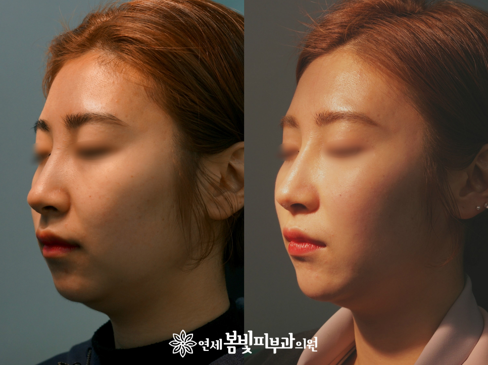 동안필러 치료 예시 #1,2 (앞광대필러, 눈물도랑필러, 볼꺼짐필러) 관련 이미지 3