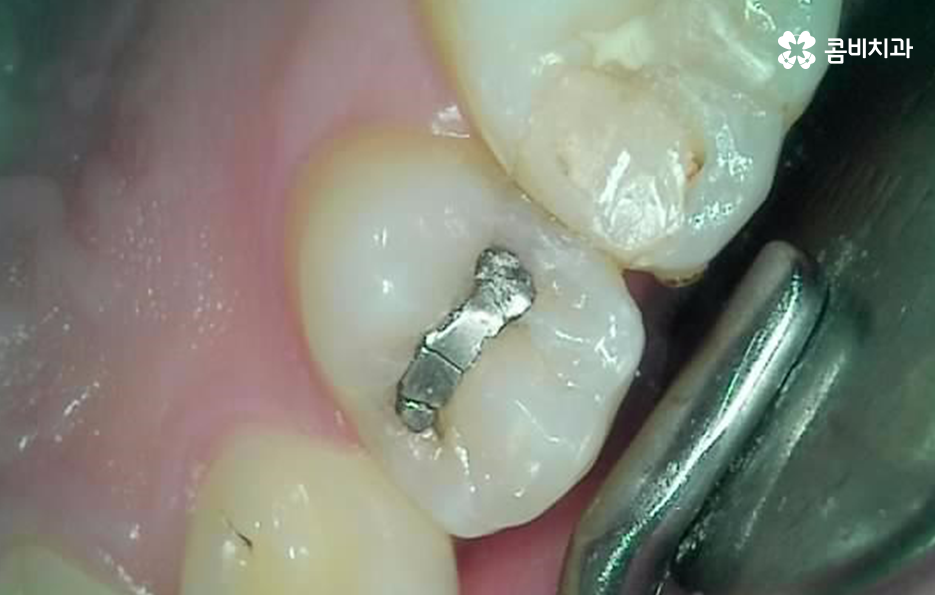 레진 인레이 치료 후 2차충치 왜 발생하고 어떻게 대처할까 관련 이미지 1
