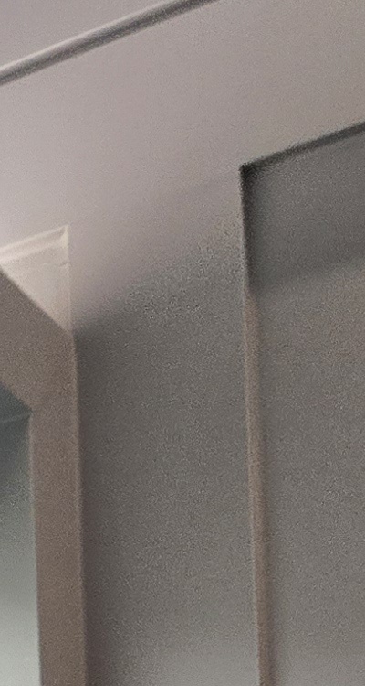 완전매복사랑니 발치 대학병원 꼭 가야하나요 관련 이미지 16