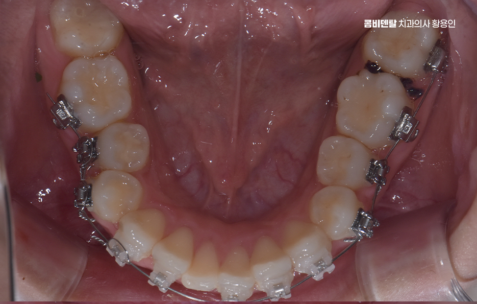 비발치 돌출입 교정 어떨때 적절할까 관련 이미지 9
