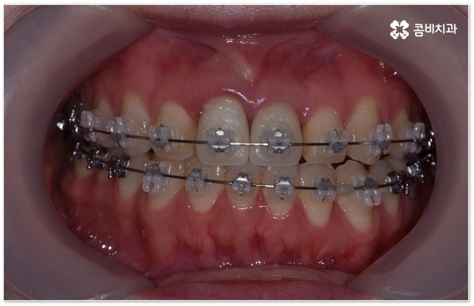 치아교정장치 어떻게 고르나요 관련 이미지 9