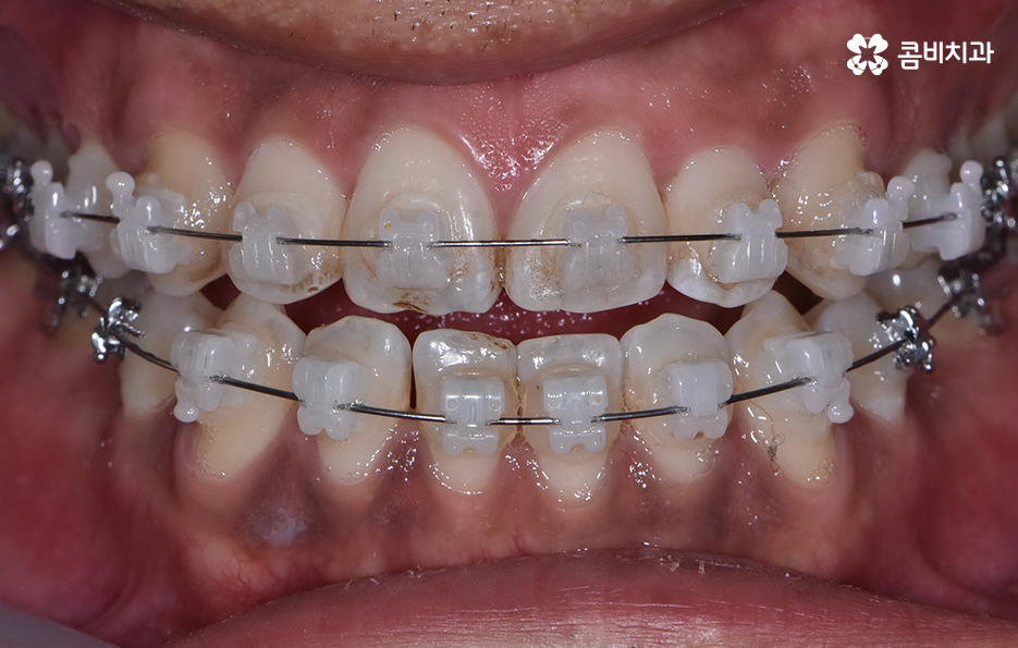 성인 부정교합 교정 더는 미루고 싶지 않다면 관련 이미지 4