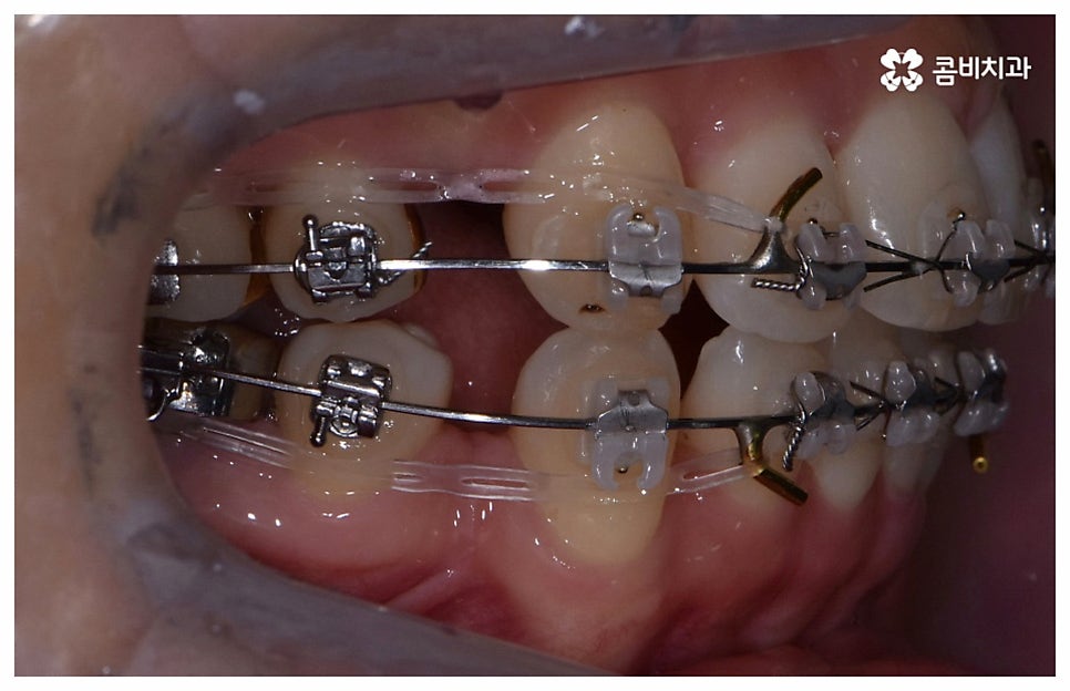 중년치아교정 원한다면 관련 이미지 11