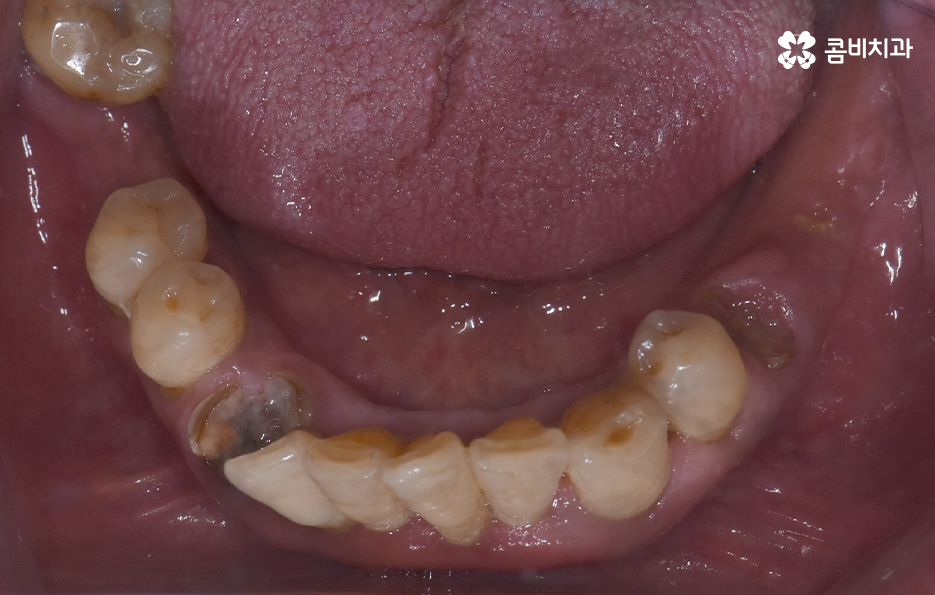 치주염 발치 이렇게나 심각하네요 관련 이미지 8