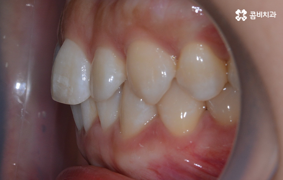 비발치치아교정 고민되는데 발치하면 안좋나요 관련 이미지 7