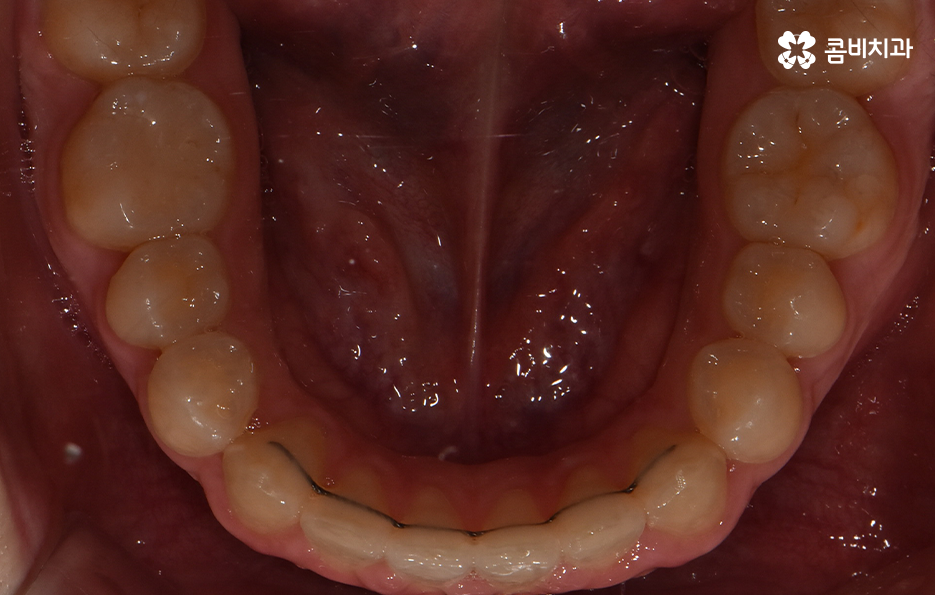 치아 벌어짐 교정으로 앞니 돌출까지 해결하기 관련 이미지 10