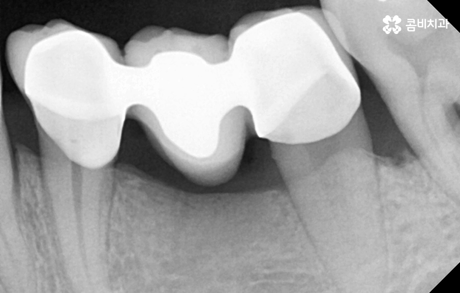 40대임플란트 치과에 이건 알고 가세요 관련 이미지 6