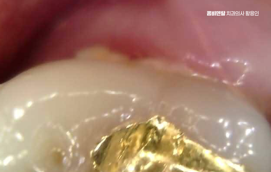 인레이 치료 후 통증 자꾸 심해지는데 괜찮은걸까 관련 이미지 8