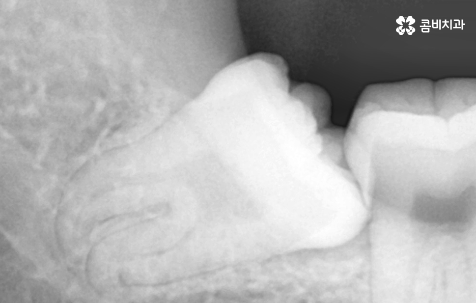 사랑니발치통증 이렇게 해야 쉬워져요 관련 이미지 2