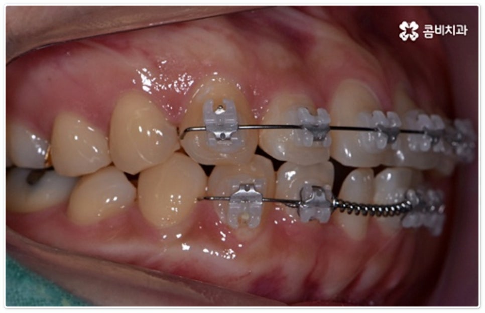 앞니부분교정 누구나 할수있나요? 관련 이미지 10