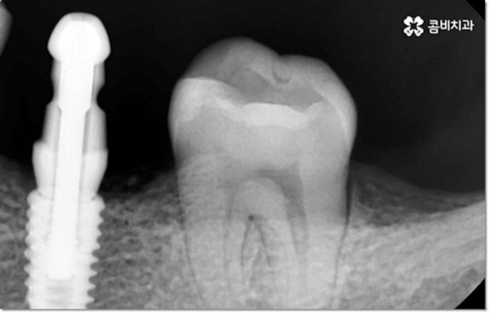 아랫니임플란트 주의할것들은? 관련 이미지 3