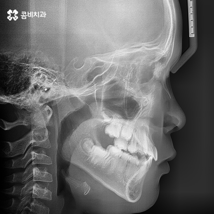 성장기치아교정 어떻게 접근하는 것이 좋을까 관련 이미지 8
